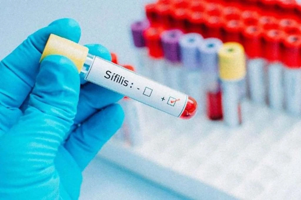 Alerta sanitaria en Argentina los casos de sífilis crecieron un 71 y marcan un récord histórico