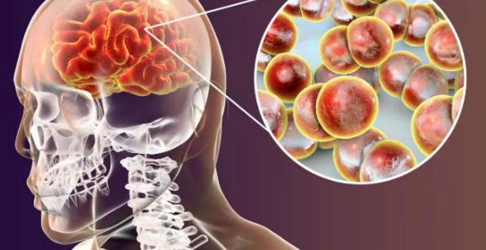 Los síntomas de la meningitis suelen aparecer de forma repentina e incluyen fiebre alta, dolor de cabeza intenso, rigidez en el cuello, sensibilidad a la luz, náuseas, vómitos y alteraciones del estado mental